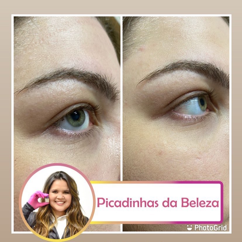 Dra. Alinne Morais Preenchimento de Olheiras #2